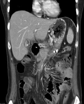 tail. (C) Before necrosectomy, CT showed walled-off pancreatic necrosis (WOPN) and air forming at necrotic pancreas fluid