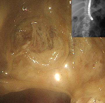 Werniche Encephalopathy after Endoscopic Necrosectomy (pancreas uncinate process), 27,, (Fig.