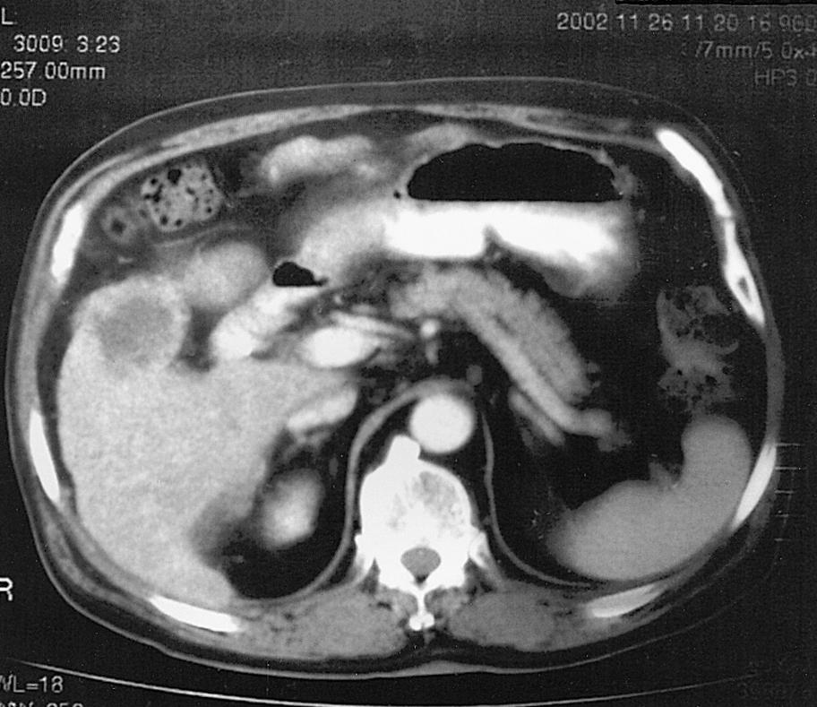 대한내과학회지 : 제 67 권 부록 3 호 2004 A B Figure 3. CT findings. (A) It shows an irregular marginated, rim-enhancing and low attenuated round mass in the GB fossa with loss of fat plane with liver.