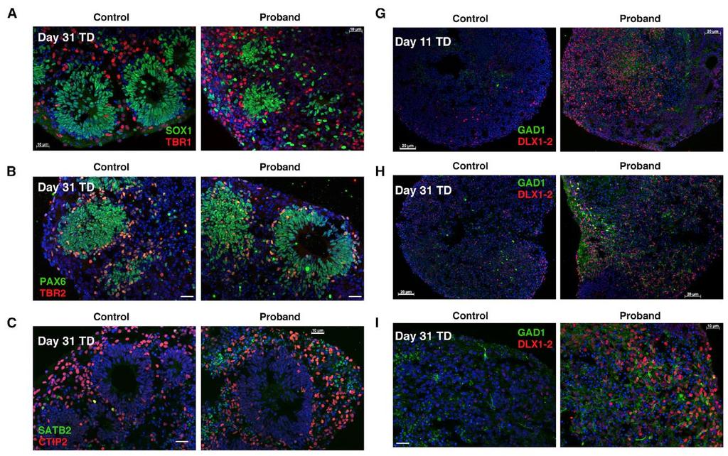 2. 자폐스펙트럼장애에서의 FOXG1 의존적 GABA 성억제신경세포분화조절실패 ASD Organoids Show Imbalance between Glutamatergic and GABAergic Neuron Fate Representative images of controlderived and ASD proband-derived organoids: -