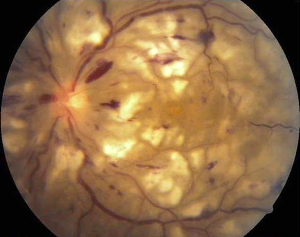 (C, D) Spectal-domein optical coherence tomographic findings showed severe macular cystoids edema (both eyes) and serous retinal