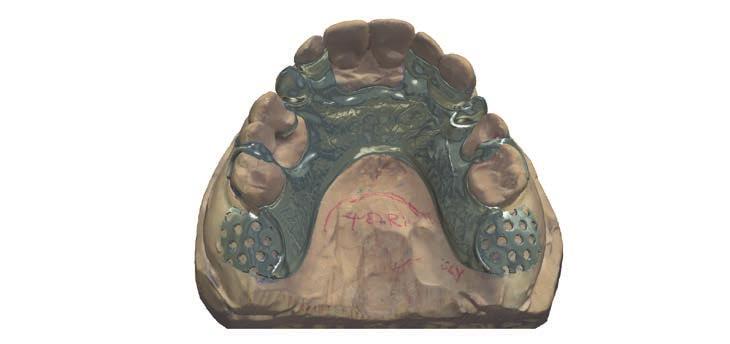 보철물작업을캡처하여임플란트시술계획및수술가이드제공 O Implant Studio 를사용하면치아기공소에서비용효율적인수술가이드를디자인 및제작하고나아가보철물임플란트시술계획을제공할수있습니다. 임플란트위치를 지정한후에는임시크라운및사용자지정복구어버트먼트등의모든보철물구성요소를 디자인하고제작할수있습니다.