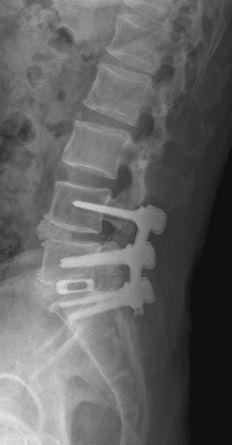 Treatment of spinal stenosis