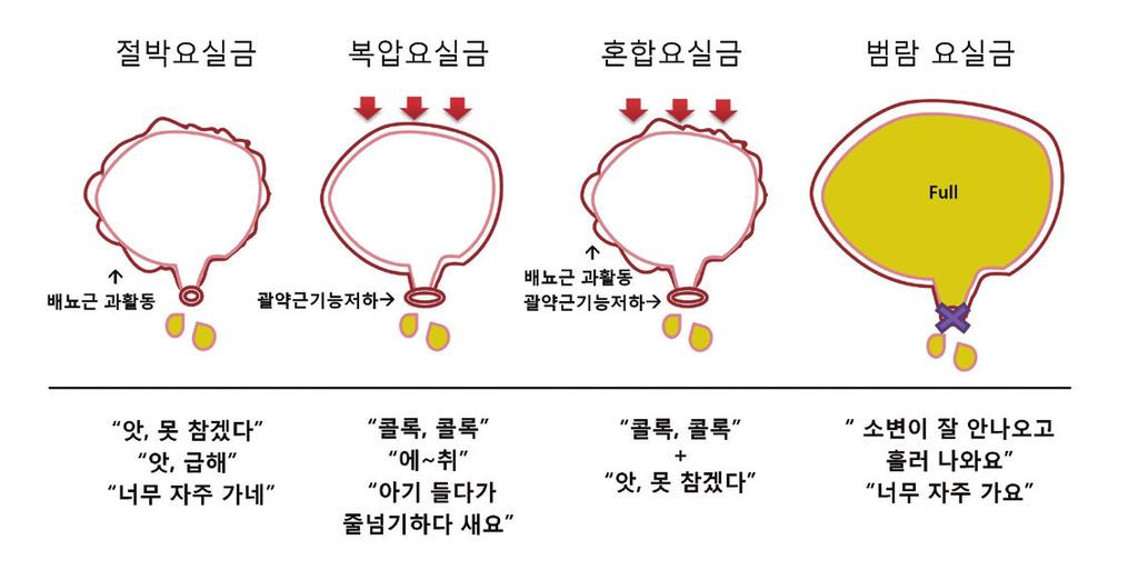 실습학생지침서 II. 요실금의종류및원인 1. 절박요실금 (Urgency incontinence) 방광의기능인저장과배출기능에문제가생기면요절박 (Urgency) 과절박요실금을유발할수있다. 절박요실금환자는갑작스런배뇨충동을느끼게되어소변이누출되는것을막지못하는데, 실제로소변이누출될때까지도소변이마렵다는생각이들지않을때도있다. 절박요실금은빈뇨, 야간뇨등의증상을동반한다.