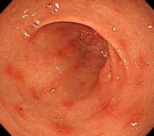 CASE 2 52YO Female History of gastric ulcer Recent stroke with aspirin Long-term use
