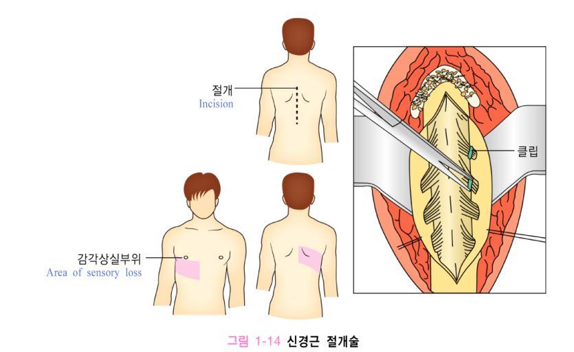 5. 약물이외의방법을이용한통증관리 4) 사회심리적간호 (1) 불안은동통을악화시키는요소이므로불안을제거 1 얼마동안환자와같이있어줌 2 환자로하여금불안을말로표현하도록유도함 3 환자와공감하며대화할의사를보임 4