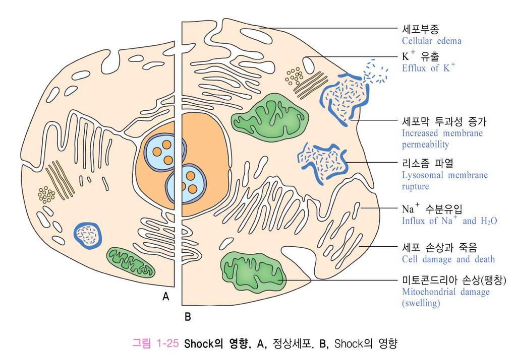 5 Shock 간호 정의 1 조직관류의전반적인감소로인한세포내저산소증 2