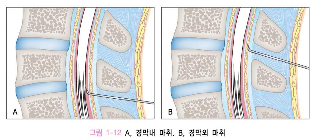 4. 약물에의한통증관리 2) 마약계약물 (Opioids) 3 주사형 정맥내주입, 피하주사효과적 정맥주사 : 효과빠르고일정수준유지가능하나비용높음