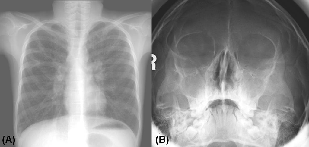 Min Jung Kim, et al.:a case Report of Classical C Pediatric Patient in Korea 낭성섬유증유병률은국가, 인종별로큰차이를보이고있다. 낭성섬유증은백인에서가장흔한유전질환중하나로 2,000-4,000 명의출생아중 1명나타나신생아선별검사를시행하고있다.