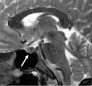 TRH stimulation test showed no significant change. A B C D Fig. 3.