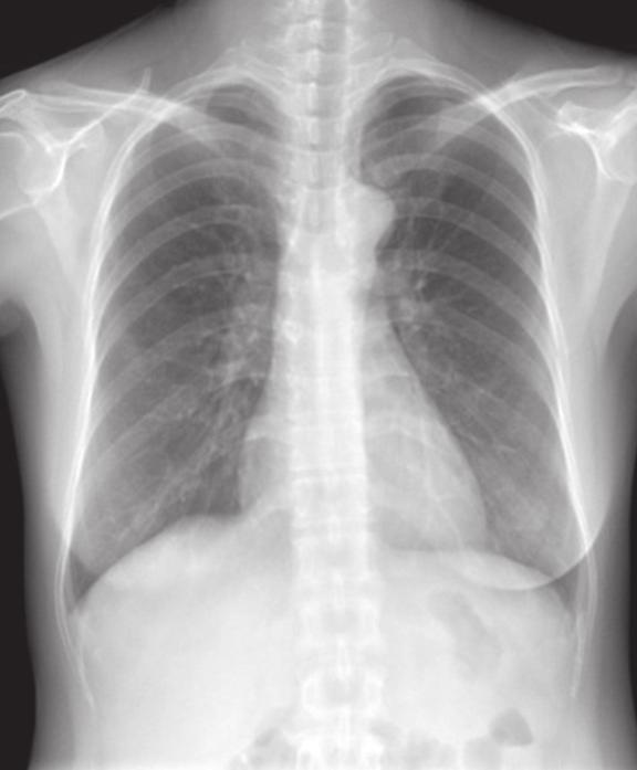 Takotsubo-like Cardiomyopathy caused by Pheochromocytoma 99 해수면위내시경, 대장내시경시행하면서 midazolam 4.5 mg, lidocaine 40 mg, buscopan 20 mg를정맥투여하였고, 시술이후 flumazenil 0.5 mg를정맥투여하였다.