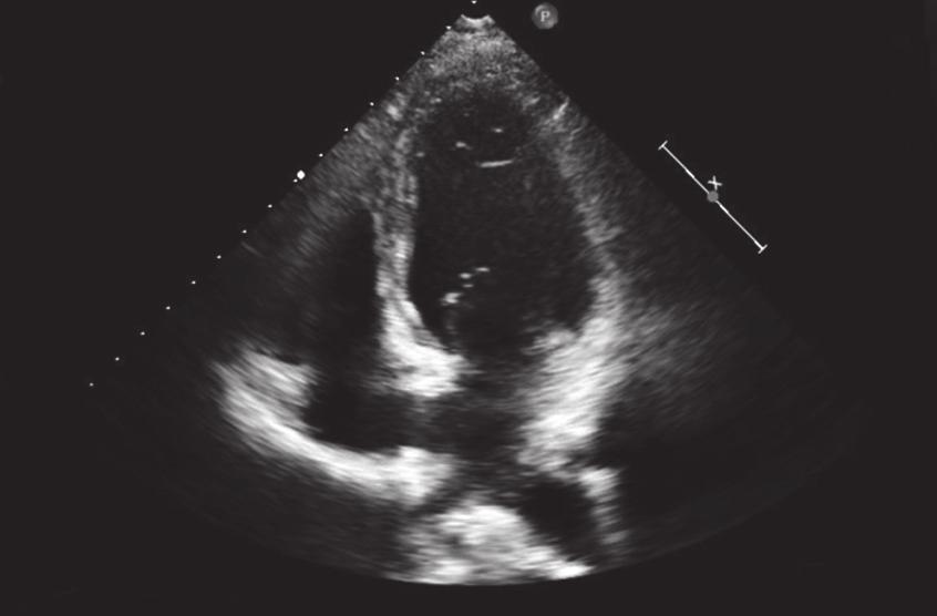100 Jang JE, et al. Fig. 2. Transthoracic echocardiography on admission.. End systole.. End diastole. It shows basal akinesia and thinning at mid to basal inferior wall with apical sparing.