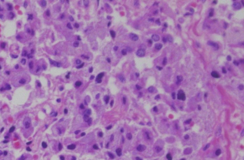 Takotsubo-like Cardiomyopathy caused by Pheochromocytoma 101 C D Fig. 4. Histologic finding of right adrenal gland.