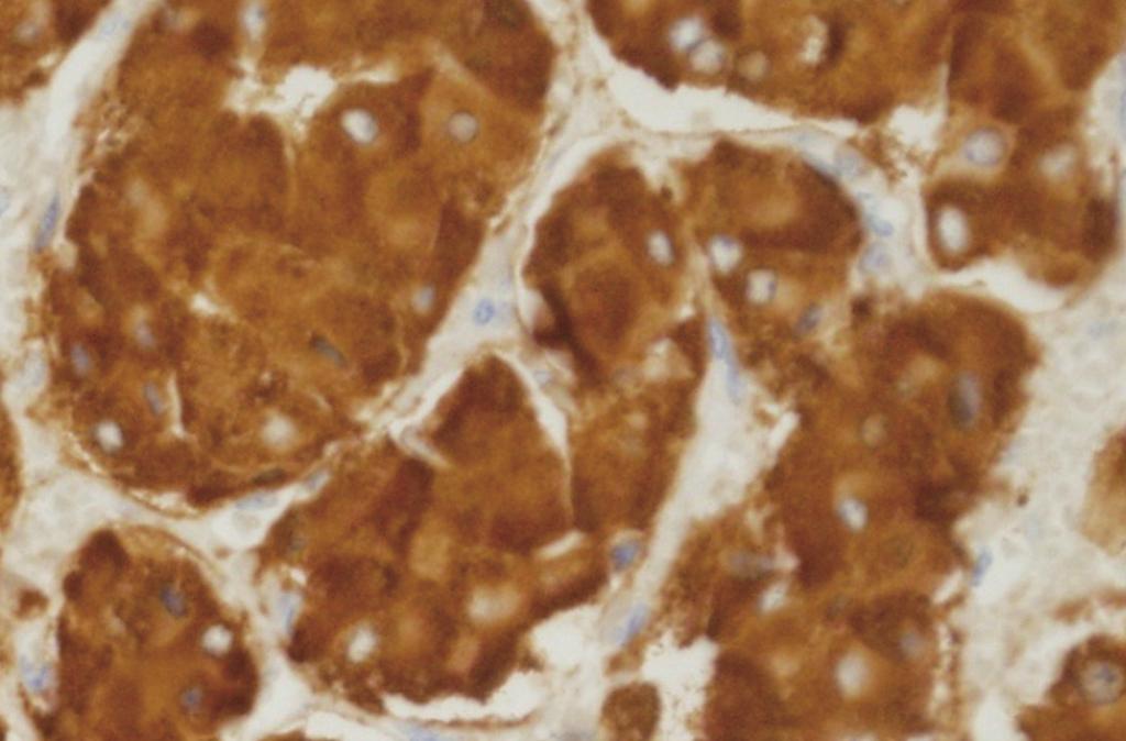 Synaptophysin staining was positive (synaptophysin, 400). D. Immunohistochemical stain for sustentacular cell, S-100 was positive reaction (S-100, 200).