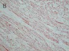 A histology examination of the pulmonary mass showed it to be well demarcated and composed of benign smooth muscle (H&E, x200) B.