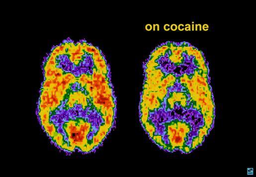 중독과뇌 두뇌비교 normal 일반사용자 메타암페타민남용자 PET( 양전자방출단층촬영 ) 빨간색부분의활성화 : 글루코스의작용