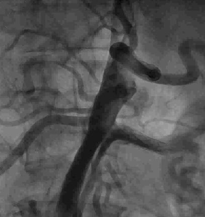 신장동맥, 상장간막동맥, 장골동맥, 경동맥등주요혈관의선택적스텐트삽입술 (selective branch artery stenting) 대동맥박리가발생해서복강동맥 (celiac trunk),