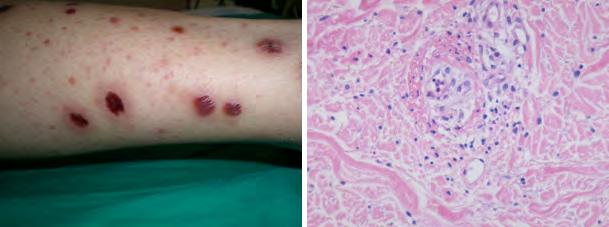 강영모 :Microscopic Polyangiitis 임상양상 소혈관혈관염가운데 ANCA와관련이있는질환인 WG, MPA, CSS은공통적으로폐와신장침범을일으키기때문에이들질환을 pulmonary renal syndrome으로부른다. 폐와신장에나타나는증상은세질환에서서로다르며질병특이적인양상을보이기도하기때문에감별진단에중요한단서가되기도한다.