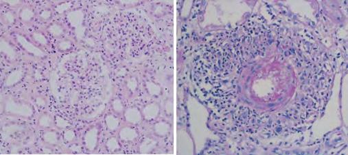 Fig. 2. 신장조직검사에괴사성혈관염소견과사구체신염소견이관찰됨. 2. 신장질환 MPA 초기연구는주로신장전문의들에의해이루어졌기때문에임상특성에대한연구에서신장침범의빈도가매우높은것으로보고되어왔으며, 일부보고들에서는모든환자에서신장침범이있다고기술하였다. MPA의정의가내려진후에발표된연구에서는신장침범의빈도가약 80% 로보고되어있어서신장질환의발생율이높은질환이다.