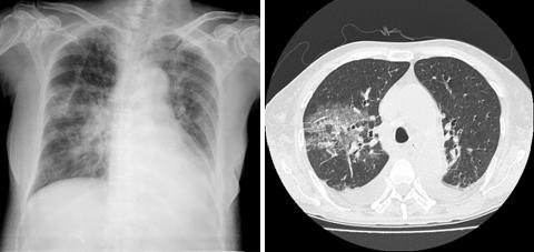 강영모 :Microscopic Polyangiitis 4. 신경침범신경질환은주로말초신경을침범하며그빈도는 10 58% 로보고되어있다. 말초신경침범은주로 mononeuritis multiplex로나타나며약 70% 를차지한다. 그외에대칭성및비대칭성의다발신경증이동반될수있다.