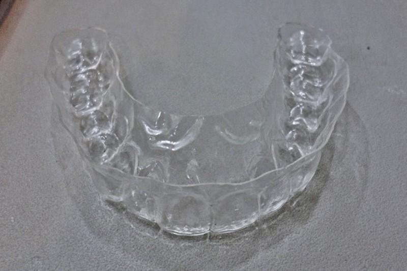 이었으며환자의아래턱을완전히제거한후인공턱을삽입함 4 치과보철미국 3D