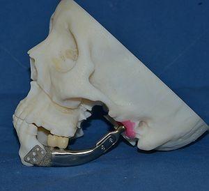 2014 년국내의료기기기업인셀루메드는엑스레이영상기반의 3D 프린팅환자맞춤형인공무릎관절치료기술을개발 기존인공관절수술의경우고정기구에맞게환자의뼈를절삭하여야했으나 3D