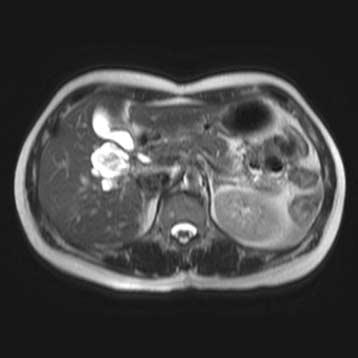 담관유두종증 447 Fig. 1. (Case 1) A computed tomographic scan shows a 4 cm sized cystic and solid mass in the segment 5 of liver (arrow).