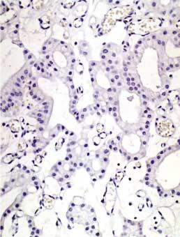 담관유두종증 449 Fig. 7. Immunohistochemistry of p53 protein. (A) There is no expression in the nuclei of tumor cells of biliary papillomatosis.