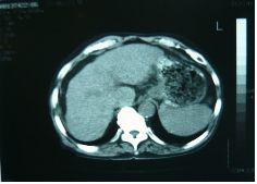 복수를동반한알코올성간경변증환자치험 1 례 a Fig. 2. Axial abdomen CT scans(a, b) shows reduction of ascites after treatment. b 2) West-medication 지셀연질캡슐 7.