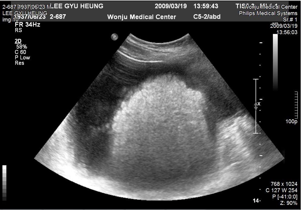 Fig. 4. Intercostal Scan by Ultrasonography shows reduction of ascites after treatment. 13. 치료내용 1) Herb-medication (Table 3) 對金飮子 ( 한중제약주식회사의 酒飮子 ) 엑기스제를 1 포당 3.0 g, 하루 3 회씩 3 포를경구투여하였음. Table 3.