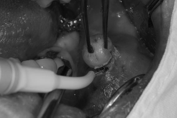 Korean Association of Maxillofacial Laser Dentistry 증례보고 43세의남자환자가좌측협점막에발생한무통성의종괴를주소로내원하였다.