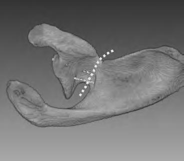 정진영 : SLAP Repair and Avoidance of SSN Injury 번 20 mm 깊이로 통과시켰을 때 anterosuperior 시점은 29% 에서 medial glenoid wall 이 통과되었고 그 중 8% 에서 신경 손상이 발생하였다.