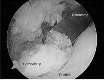 Débridement of the anterior joint focuses on the radial and coronoid fossae; the coronoid tip is excised; capsulotomy is done if needed (in extension deficit);