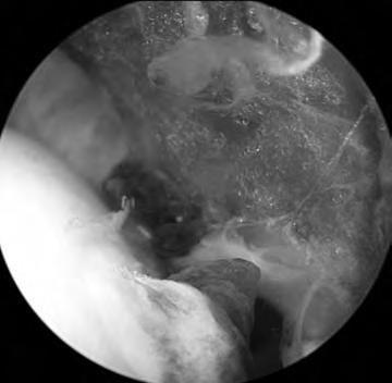 이주엽 : Radial Head and Coronoid Screw Fixation: Arthroscopic vs Open 수술 방법 : 요골 두 골절 요골 두 골절의 수술적 치료를 위하여 먼저 후외방 삽입구로 전반적인 요골 두 골절의 형태를 확인할 수 있다.