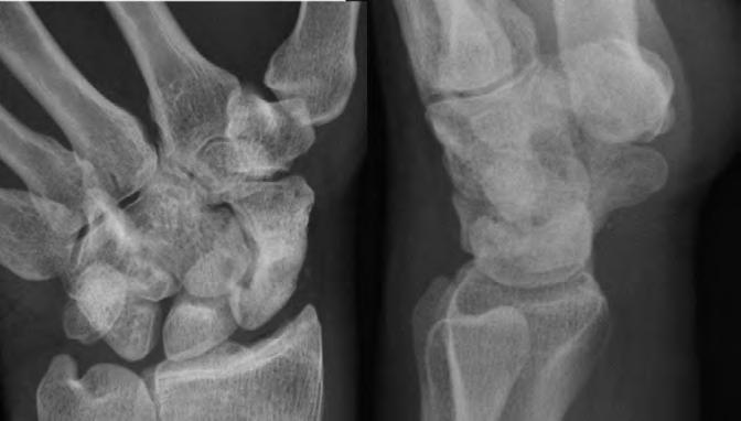 이영근 : Arthroscopic Treatment for Scaphoid Fracture or Nonunion 골 능에서 해면골을 채취하였다. 그리고 가위를 이용해 채취한 골을 작은 조각으로 미리 잘라 준비하였다. 골이식은 중수근 척측 삽입구를 통해 관절경으로 불유합 부위를 지속적으로 보여주도록 한 상태에서, 중수근 요측 삽입구를 통해 3.