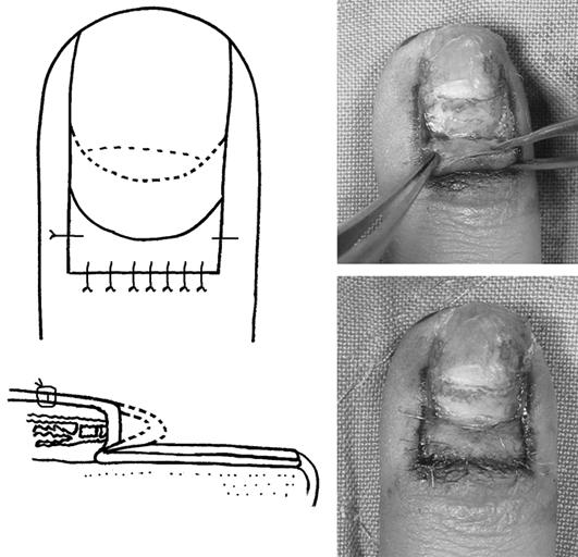 450 이충훈ㆍ정준모ㆍ김진호외 4 인 있는손톱뿌리 (nail root) 를드러내겉으로보이는손톱의길이를늘여손톱의전체적인모양개선효과가있다. 짧아진손톱길이를늘리는데에있어, 손톱위허물피판술은환자의만족도가높고, 효과적이면서도간단하고안전한방법으로생각하여보고하고자한다. 대상및방법 1.