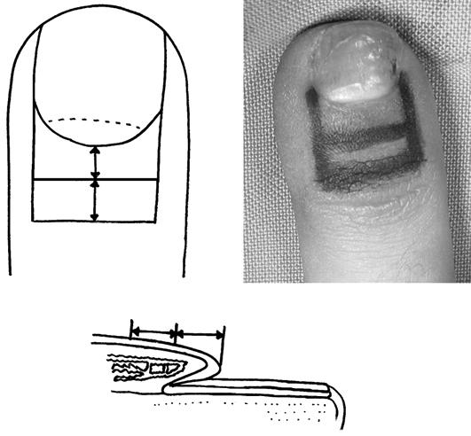 환자나이는평균 30.4세 (20-59세) 이었으며, 무지가 2예, 인지와중지가각각 6예, 환지가 3예, 소지가 8예였다. 2. 수술방법 (Fig. 1) 수술은수지부분마취와손가락지혈대하에서시행하였다. 손톱위허물의원위부끝으로부터 0.4-0.6 cm 근위부에 0.3-0.