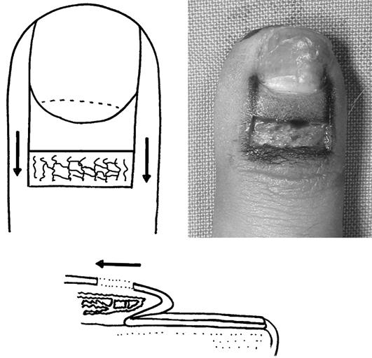 1) 피판의양쪽경계는전층깊이로절개하고손톱위허물을조심스럽게손톱으로부터분리하였다. 손톱판과옆피부로부터유리된손톱위허물피판을근위부로이동시켜상피제거부위를덮고 6-0 나일론으로봉합하여결과적으로손톱이보이는부분이길어지도록하였다. 술후항생제투약과상처치료이외에특별한약물투여나조작은하지않았다. 술후 2주째봉합사를제거하였다.
