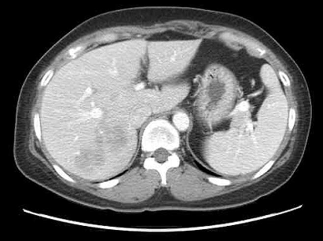 - Dong Wook Joo, et al. Toxocariasis presenting as liver abscess - A B Figure 2. Abdominal computed tomography (CT) findings. (A) CT scan shows a 6.