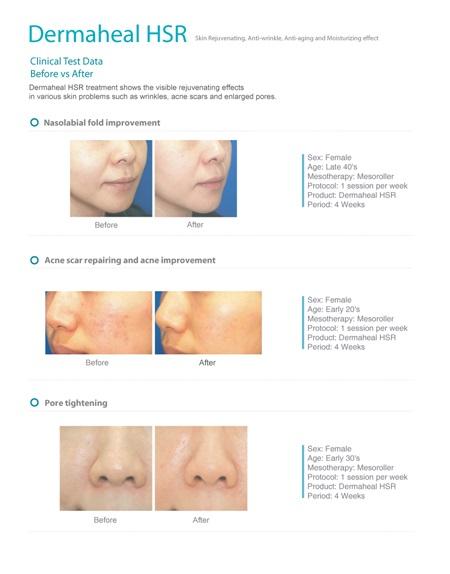 ( 나 ) 레보필아쿠아샤인 (REVOFIL Aquashine) 안면미용시술용더말필러 (Dermal Filler) 제품으로서기존히알루론산필러에당사의주름개선,