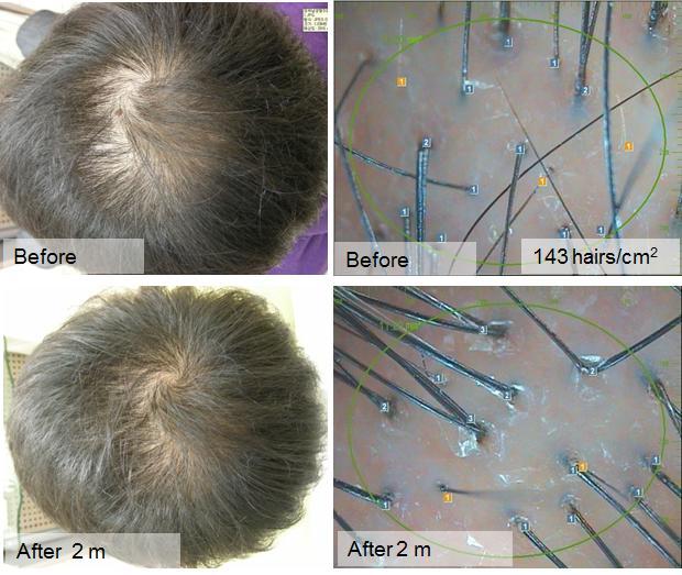 ( 라 ) 닥터씨와이제이헤어필러엑셀세럼 (Dr.CYJ Hair Filler excell C'rum) 발모, 탈모방지전문메조테라피제품으로당사가개발한발모촉진, 탈모방지, 세포활성과관련된 7 가지의펩타이드효능원료를고농축으로함유한제품입니다.