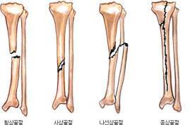 6압박 : 순수한압박이골간부의골절을일으키지않고, 단단한간부가해면성조직으로눌려들어가서골단과골간단을경유하는 Y형, T형골절 2) 골절선의형태에의한분류