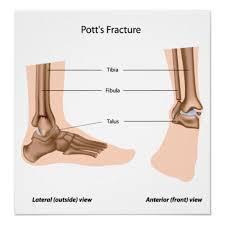 (2)Pott의골절 : 1원인 : 발의외반력혹은내반력 2동반 : 거골측방아탈구와함께삼각인대파열 3골절의높이 : 비골의족관절상방 5~8cm 4분류 a.