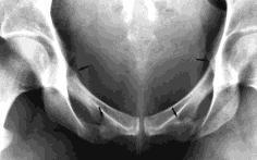 B. 골반환골절 (1) 안정성골절 1장골익골절 =Duverney골절 2하부천골횡골결 골반골절중가장많은빈도 3치골지골절 4치골결합부분리 (2) 불안정성골절