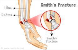 (2) Smith 골절 (= 역 Colles 골절 ) 1정의 : 원위골절편이전방으로전위된요골원위부골절 2발생 :
