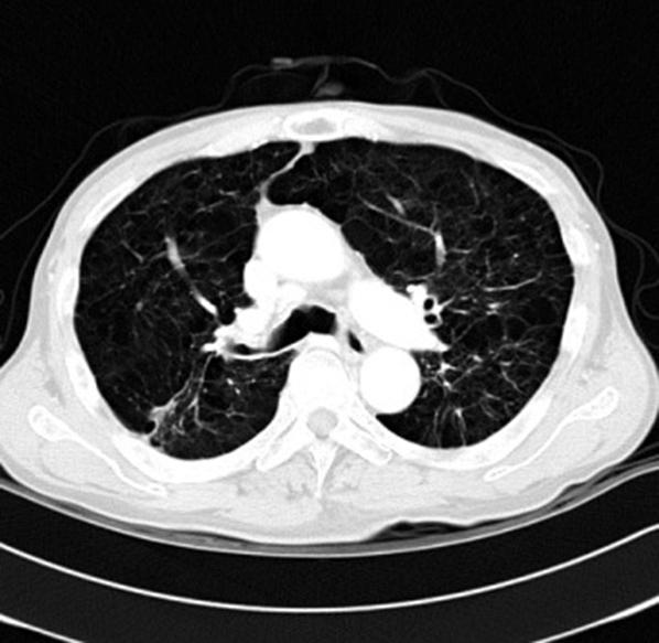 Chest radiography and chest CT during diagnosis and more than 2 months after treatments.