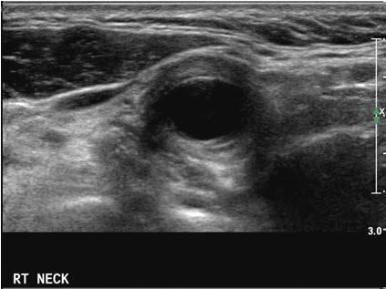 전북대학교병원 ) 49 세여자환자가최근에발생한 Rt postauricular and upper cervical area