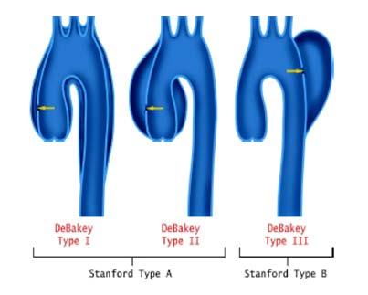 받고있다. 급성대동맥증후군 (acute aortic syndrome) 은갑자기발생하는심한흉통이나후흉벽통을호소하며응급실에내원하는환자로 aortic dissection (AD), intramural hematoma (IMH), penetrating atherosclerotic ulcer (PAU) 그외 traumatic aortic injury가있다. 1.