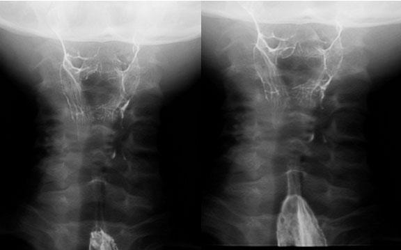 <Esophagography> Case 8.