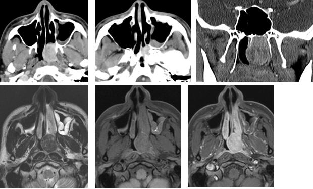 7% of all sinonasal tumors Imaging features Almost U/L, sinus wall focal hyperostosis, expansion,